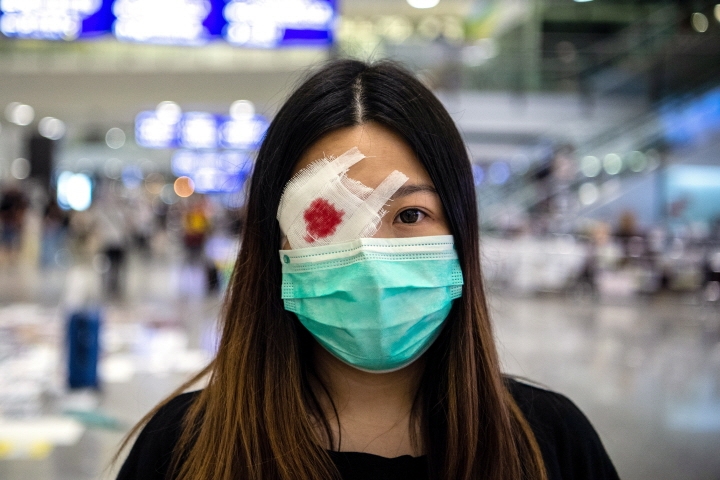 경찰의 홍콩시위 강경진압을 비판하는 취지에서  눈을 다친 모습을 연출했다. [사진=연합뉴스]